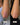 a person's elbow before and after
